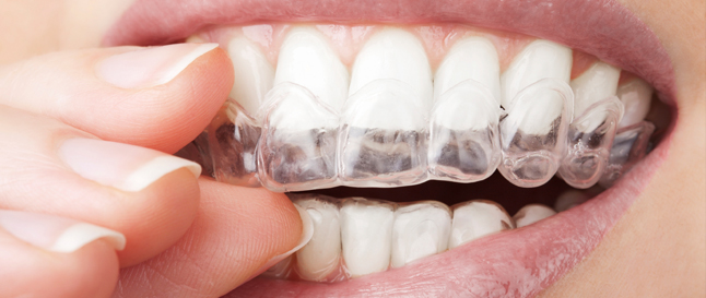 Clear Aligner