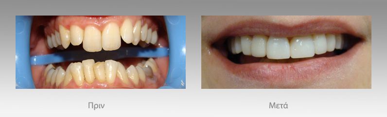 Αισθητική οδοντιατρική: πριν και μετά