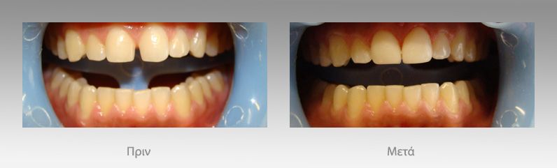 Αισθητική οδοντιατρική: πριν και μετά