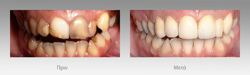 Αισθητική οδοντιατρική: πριν και μετά