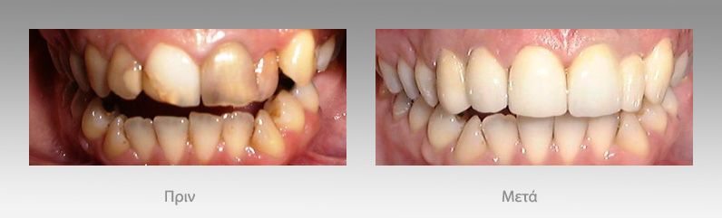 Προσθετική οδοντιατρική: πριν και μετά