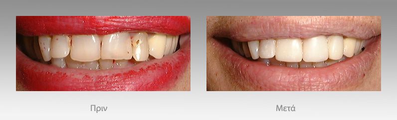 Προσθετική οδοντιατρική: πριν και μετά