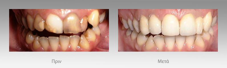 Προσθετική οδοντιατρική: πριν και μετά