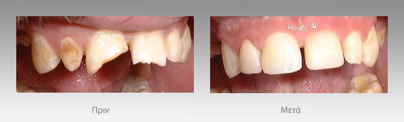 Προσθετική οδοντιατρική: πριν και μετά